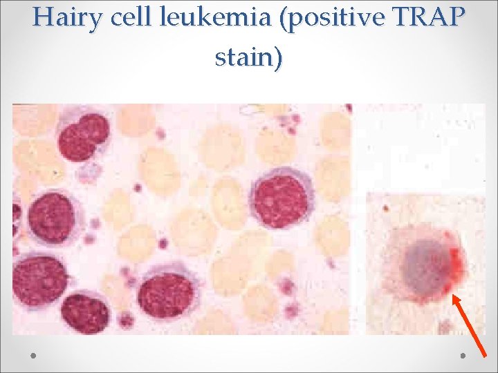 Hairy cell leukemia (positive TRAP stain) 