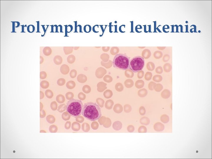 Prolymphocytic leukemia. 