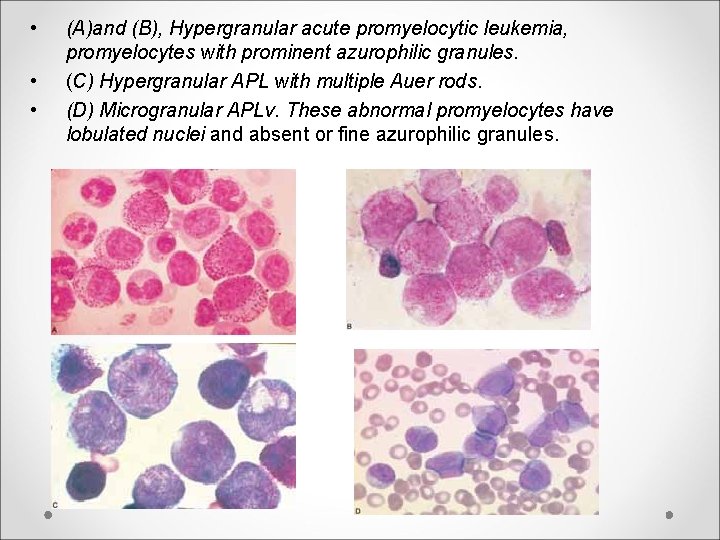  • • • (A)and (B), Hypergranular acute promyelocytic leukemia, promyelocytes with prominent azurophilic