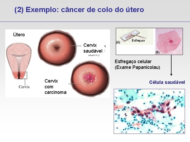 (2) Exemplo: câncer de colo do útero Útero Cervix saudável Esfregaço celular (Exame Papanicolau)