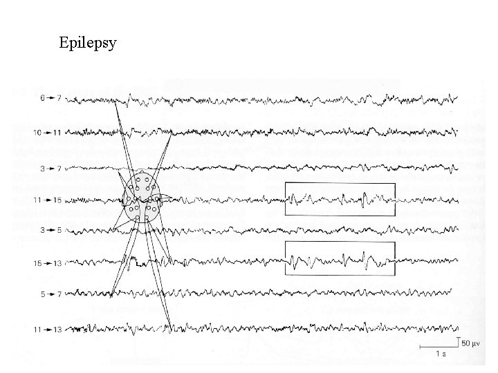 Epilepsy 