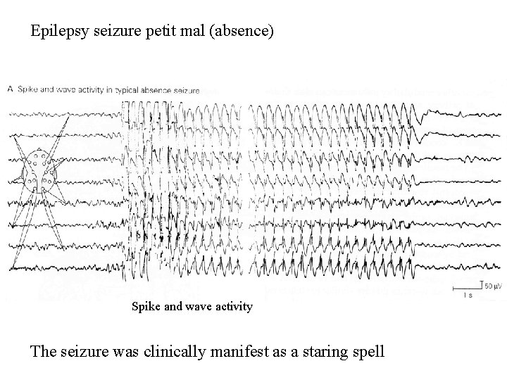 Epilepsy seizure petit mal (absence) Spike and wave activity The seizure was clinically manifest