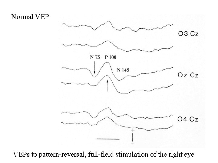 Normal VEPs to pattern-reversal, full-field stimulation of the right eye Normal VEPs to pattern-reversal, full-field stimulation of the right eye