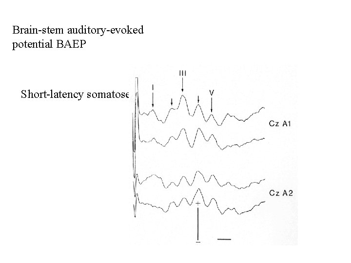 Brain-stem auditory-evoked potential BAEP Short-latency somatosensory-evoked potential SSEP 