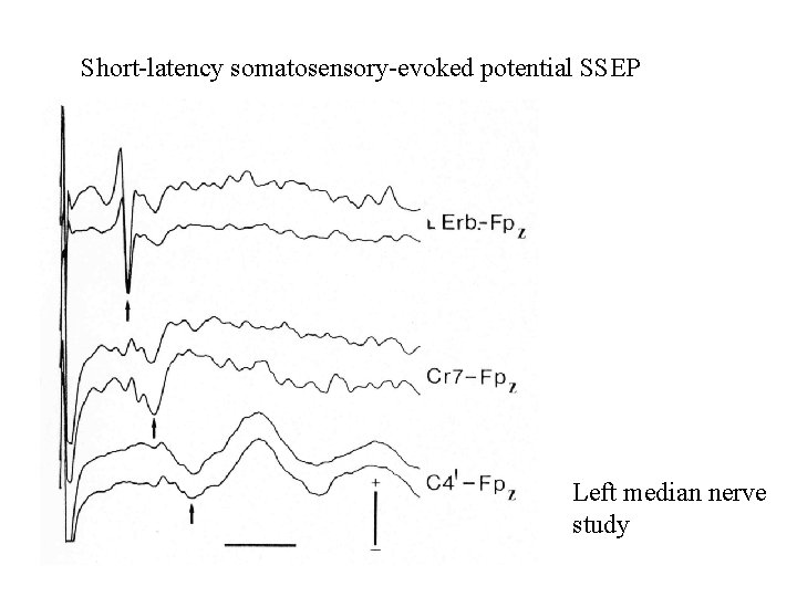 Short-latency somatosensory-evoked potential SSEP Left median nerve study 