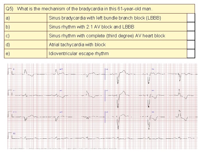 Q 5) What is the mechanism of the bradycardia in this 61 -year-old man.