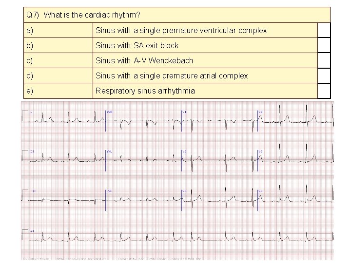 Q 7) What is the cardiac rhythm? a) Sinus with a single premature ventricular