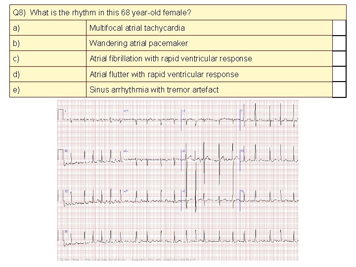Q 8) What is the rhythm in this 68 year-old female? a) Multifocal atrial