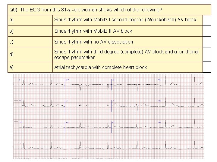 Q 9) The ECG from this 81 -yr-old woman shows which of the following?