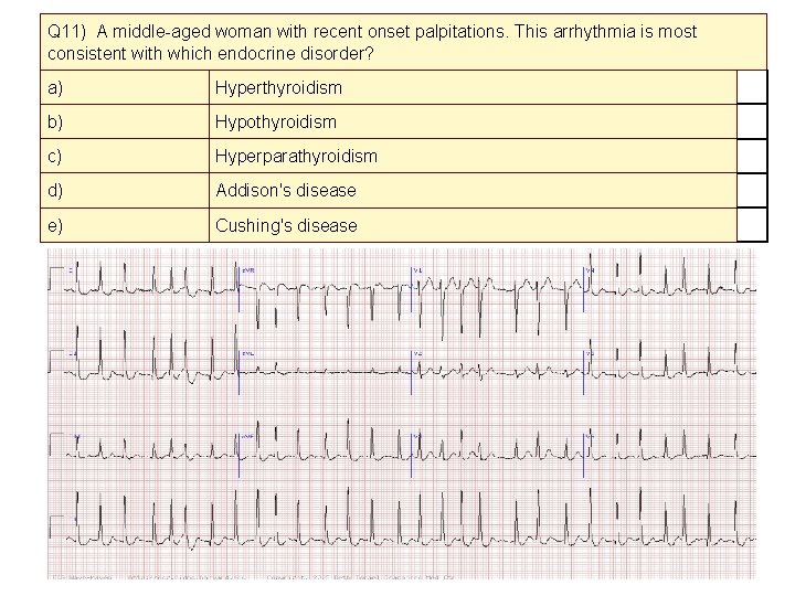 Q 11) A middle-aged woman with recent onset palpitations. This arrhythmia is most consistent