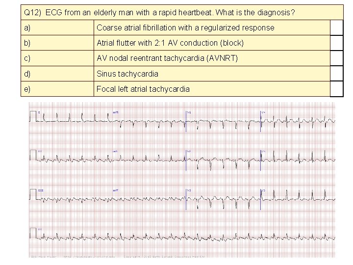 Q 12) ECG from an elderly man with a rapid heartbeat. What is the