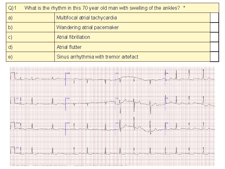Q)1 What is the rhythm in this 70 year old man with swelling of