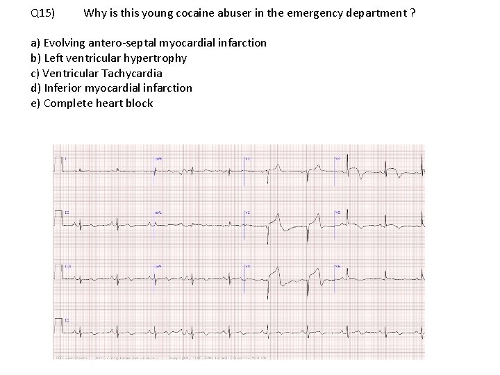 Q 15) Why is this young cocaine abuser in the emergency department ? a)