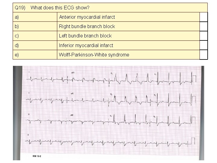Q 19) What does this ECG show? a) Anterior myocardial infarct b) Right bundle