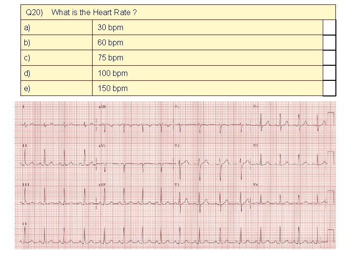 Q 20) What is the Heart Rate ? a) 30 bpm b) 60 bpm