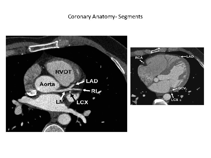 Coronary Anatomy- Segments 