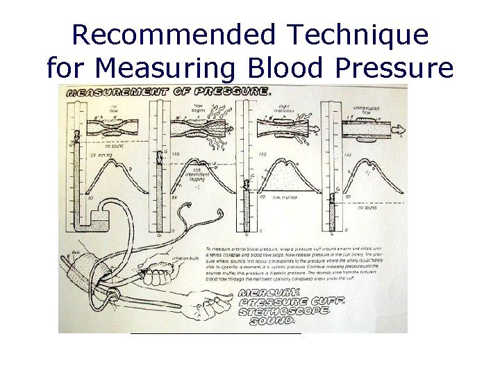 Recommended Technique for Measuring Blood Pressure (cont. ) Korotkoff sounds 200 180 160 No Recommended Technique for Measuring Blood Pressure (cont. ) Korotkoff sounds 200 180 160 No