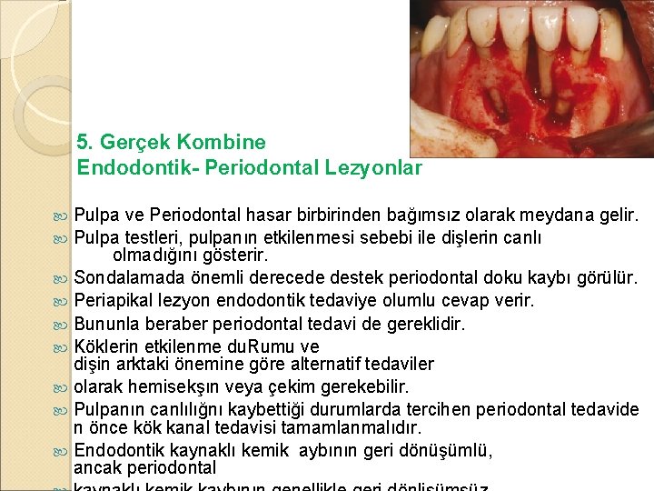 5. Gerçek Kombine Endodontik- Periodontal Lezyonlar Pulpa ve Periodontal hasar birbirinden bağımsız olarak meydana