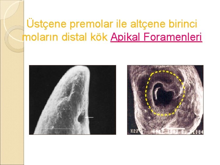 Üstçene premolar ile altçene birinci moların distal kök Apikal Foramenleri 