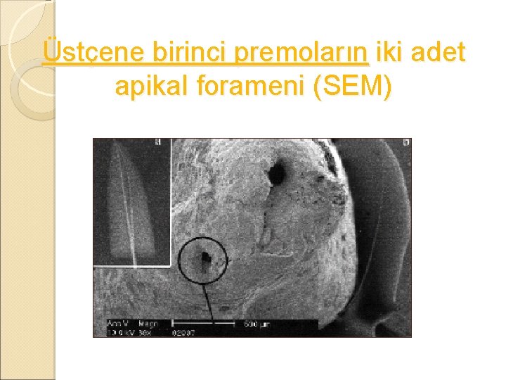 Üstçene birinci premoların iki adet apikal forameni (SEM) 