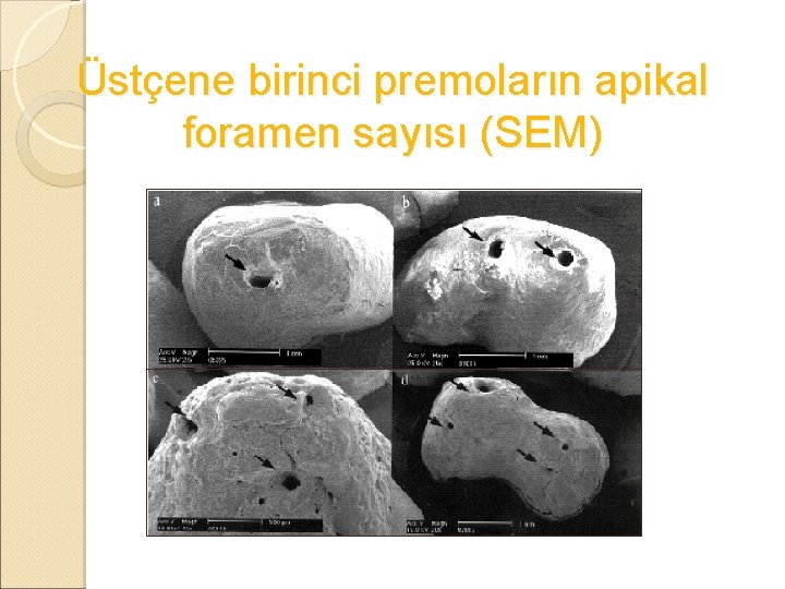 Üstçene birinci premoların apikal foramen sayısı (SEM) 