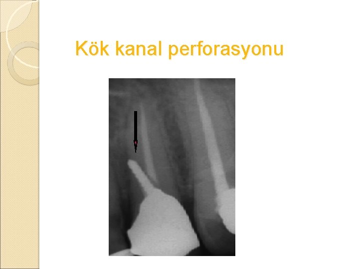 Kök kanal perforasyonu 