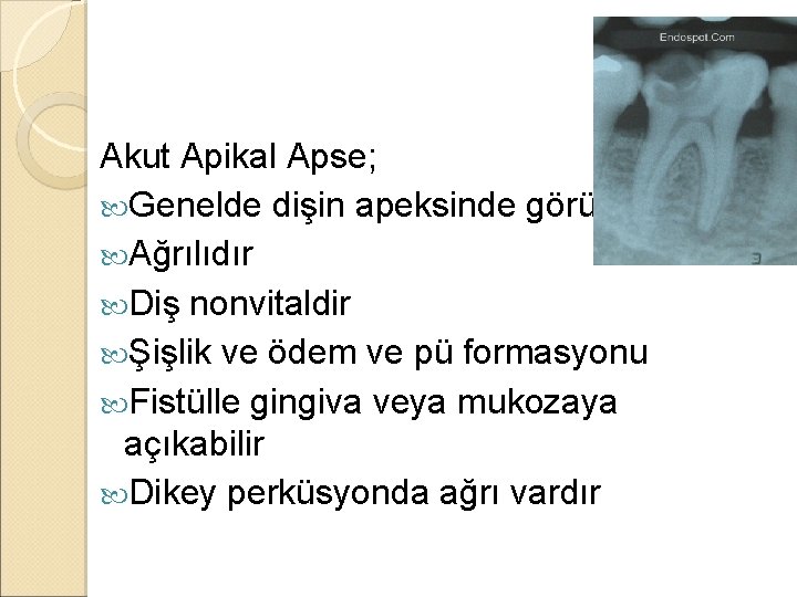 Akut Apikal Apse; Genelde dişin apeksinde görülür Ağrılıdır Diş nonvitaldir Şişlik ve ödem ve