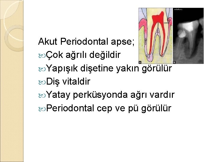 Akut Periodontal apse; Çok ağrılı değildir Yapışık dişetine yakın görülür Diş vitaldir Yatay perküsyonda