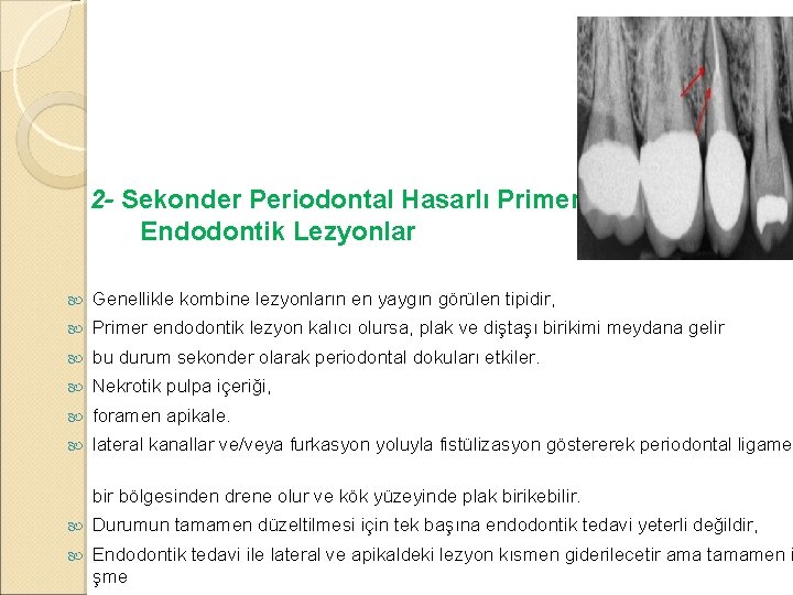 2 - Sekonder Periodontal Hasarlı Primer Endodontik Lezyonlar Genellikle kombine lezyonların en yaygın görülen