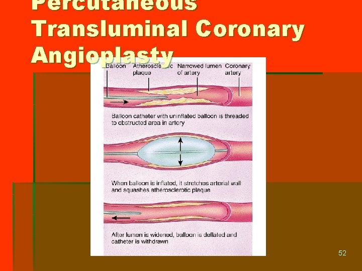 Percutaneous Transluminal Coronary Angioplasty 52 