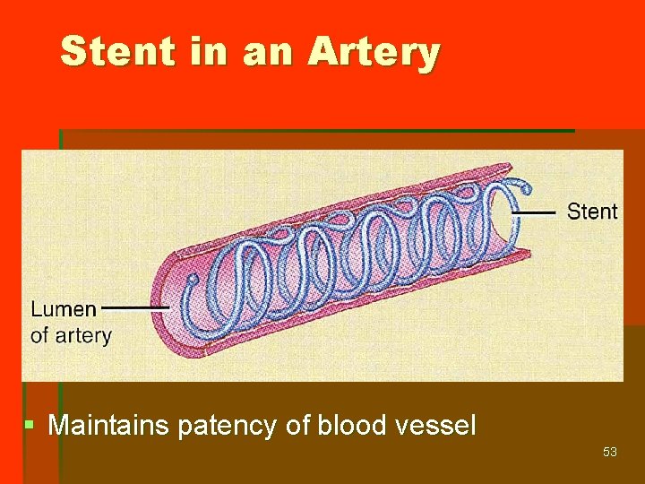 Stent in an Artery § Maintains patency of blood vessel 53 