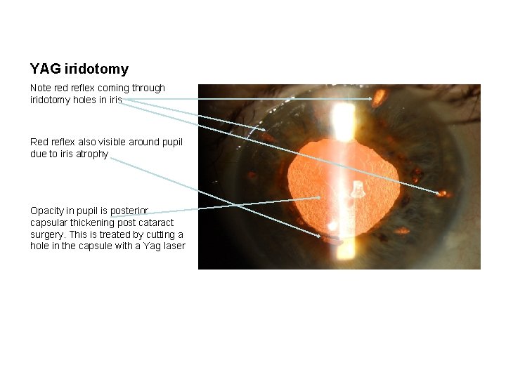 YAG iridotomy Note red reflex coming through iridotomy holes in iris Red reflex also