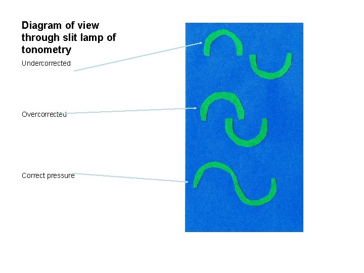 Diagram of view through slit lamp of tonometry Undercorrected Overcorrected Correct pressure 