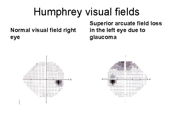 Humphrey visual fields Normal visual field right eye Superior arcuate field loss in the