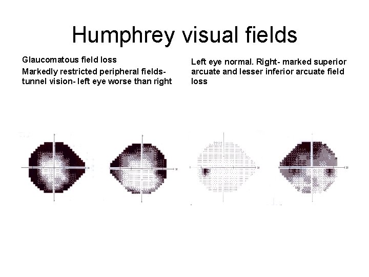 Humphrey visual fields Glaucomatous field loss Markedly restricted peripheral fieldstunnel vision- left eye worse