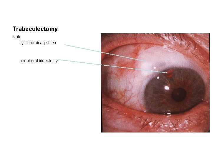 Trabeculectomy Note cystic drainage bleb peripheral iridectomy 