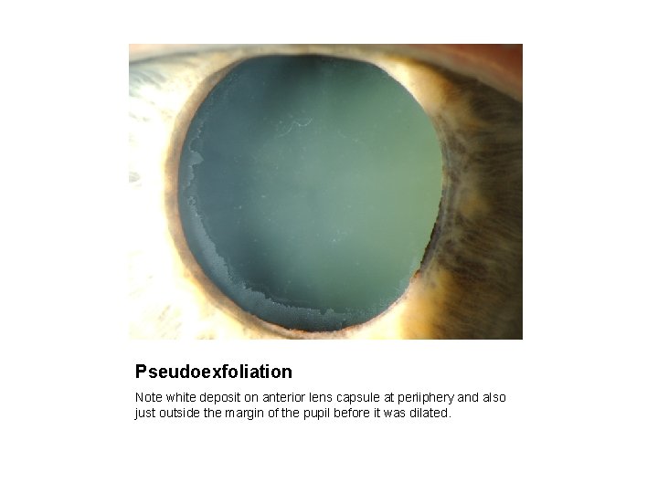 Pseudoexfoliation Note white deposit on anterior lens capsule at periiphery and also just outside