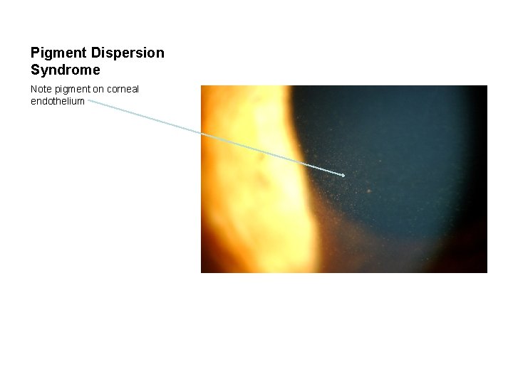 Pigment Dispersion Syndrome Note pigment on corneal endothelium 