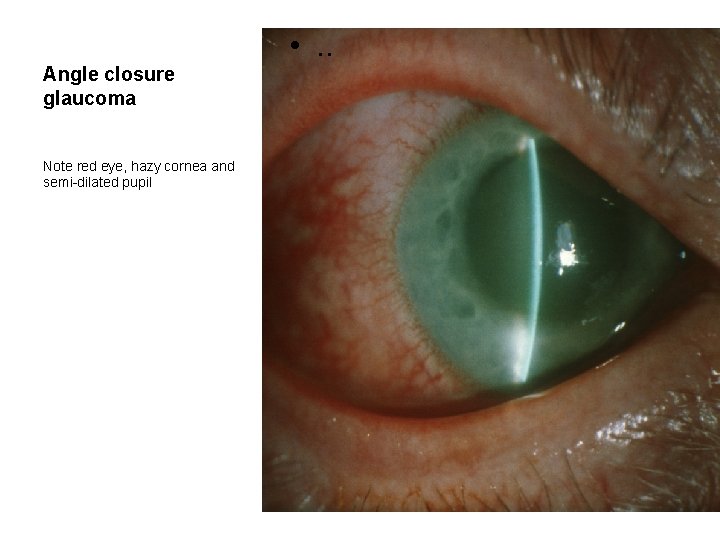 Angle closure glaucoma Note red eye, hazy cornea and semi-dilated pupil • . .