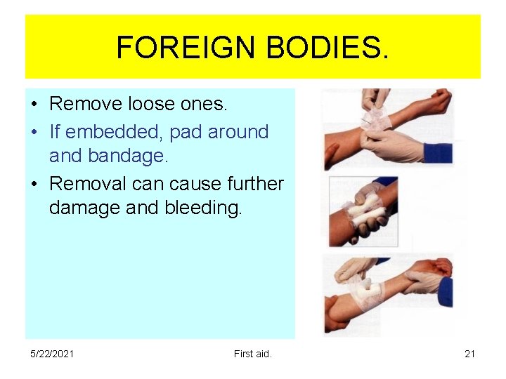 FOREIGN BODIES. • Remove loose ones. • If embedded, pad around and bandage. • FOREIGN BODIES. • Remove loose ones. • If embedded, pad around and bandage. •