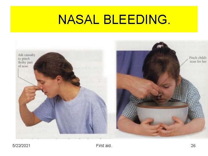NASAL BLEEDING. 5/22/2021 First aid. 26 NASAL BLEEDING. 5/22/2021 First aid. 26