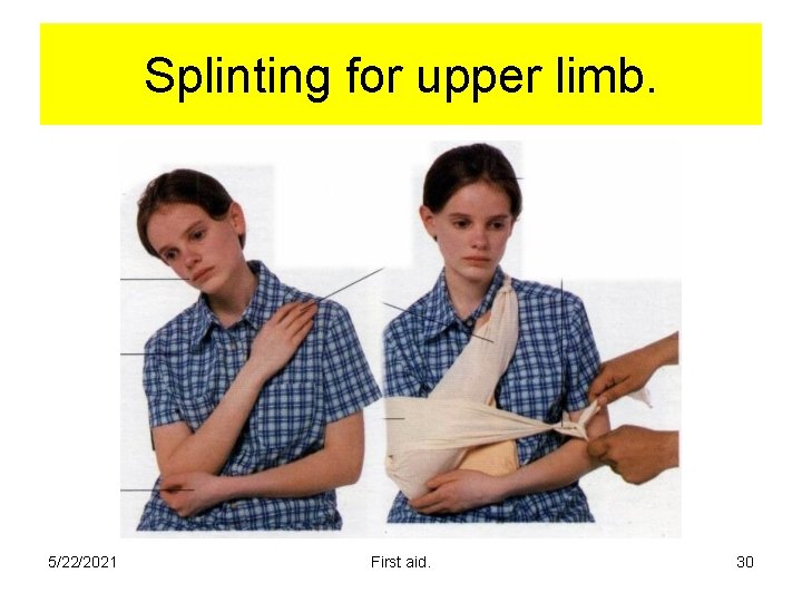 Splinting for upper limb. 5/22/2021 First aid. 30 Splinting for upper limb. 5/22/2021 First aid. 30