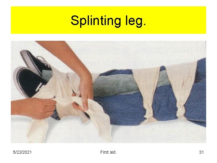 Splinting leg. 5/22/2021 First aid. 31 Splinting leg. 5/22/2021 First aid. 31