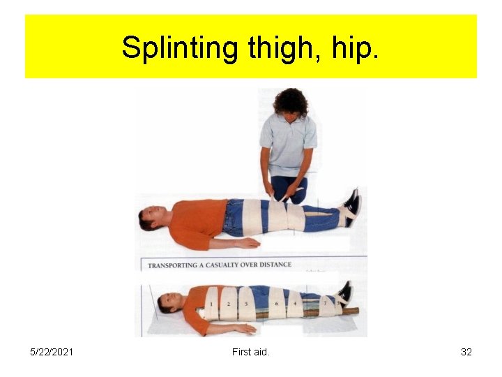 Splinting thigh, hip. 5/22/2021 First aid. 32 Splinting thigh, hip. 5/22/2021 First aid. 32