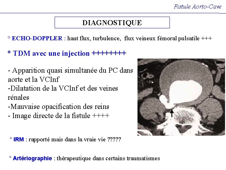 Fistule Aorto-Cave DIAGNOSTIQUE ° ECHO-DOPPLER : haut flux, turbulence, flux veineux fémoral pulsatile +++ Fistule Aorto-Cave DIAGNOSTIQUE ° ECHO-DOPPLER : haut flux, turbulence, flux veineux fémoral pulsatile +++