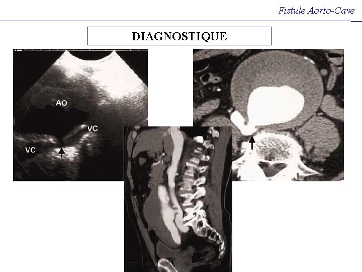 Fistule Aorto-Cave DIAGNOSTIQUE Fistule Aorto-Cave DIAGNOSTIQUE