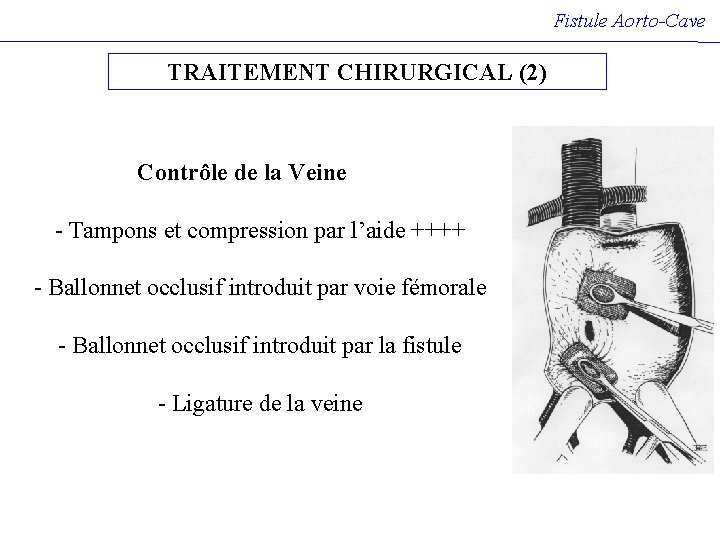 Fistule Aorto-Cave TRAITEMENT CHIRURGICAL (2) Contrôle de la Veine - Tampons et compression par Fistule Aorto-Cave TRAITEMENT CHIRURGICAL (2) Contrôle de la Veine - Tampons et compression par