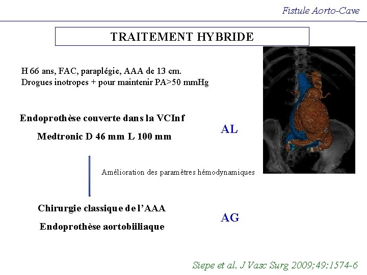 Fistule Aorto-Cave TRAITEMENT HYBRIDE H 66 ans, FAC, paraplégie, AAA de 13 cm. Drogues Fistule Aorto-Cave TRAITEMENT HYBRIDE H 66 ans, FAC, paraplégie, AAA de 13 cm. Drogues