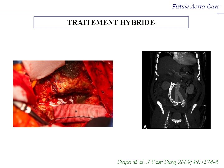 Fistule Aorto-Cave TRAITEMENT HYBRIDE Siepe et al. J Vasc Surg 2009; 49: 1574 -6 Fistule Aorto-Cave TRAITEMENT HYBRIDE Siepe et al. J Vasc Surg 2009; 49: 1574 -6