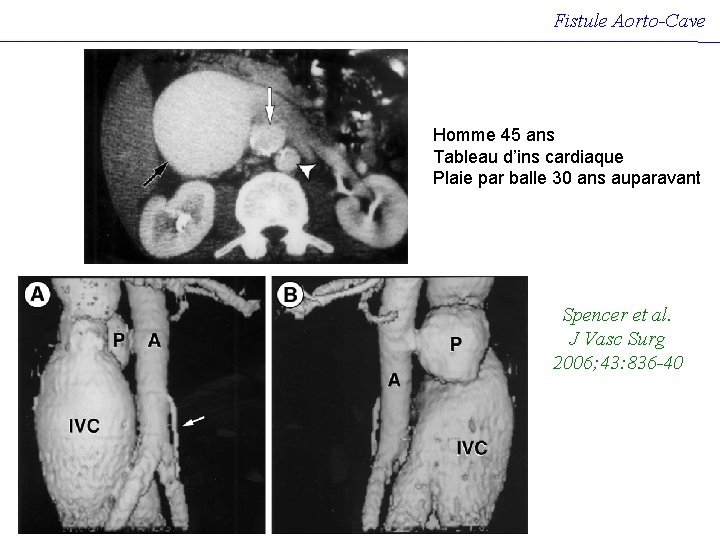 Fistule Aorto-Cave Homme 45 ans Tableau d’ins cardiaque Plaie par balle 30 ans auparavant Fistule Aorto-Cave Homme 45 ans Tableau d’ins cardiaque Plaie par balle 30 ans auparavant